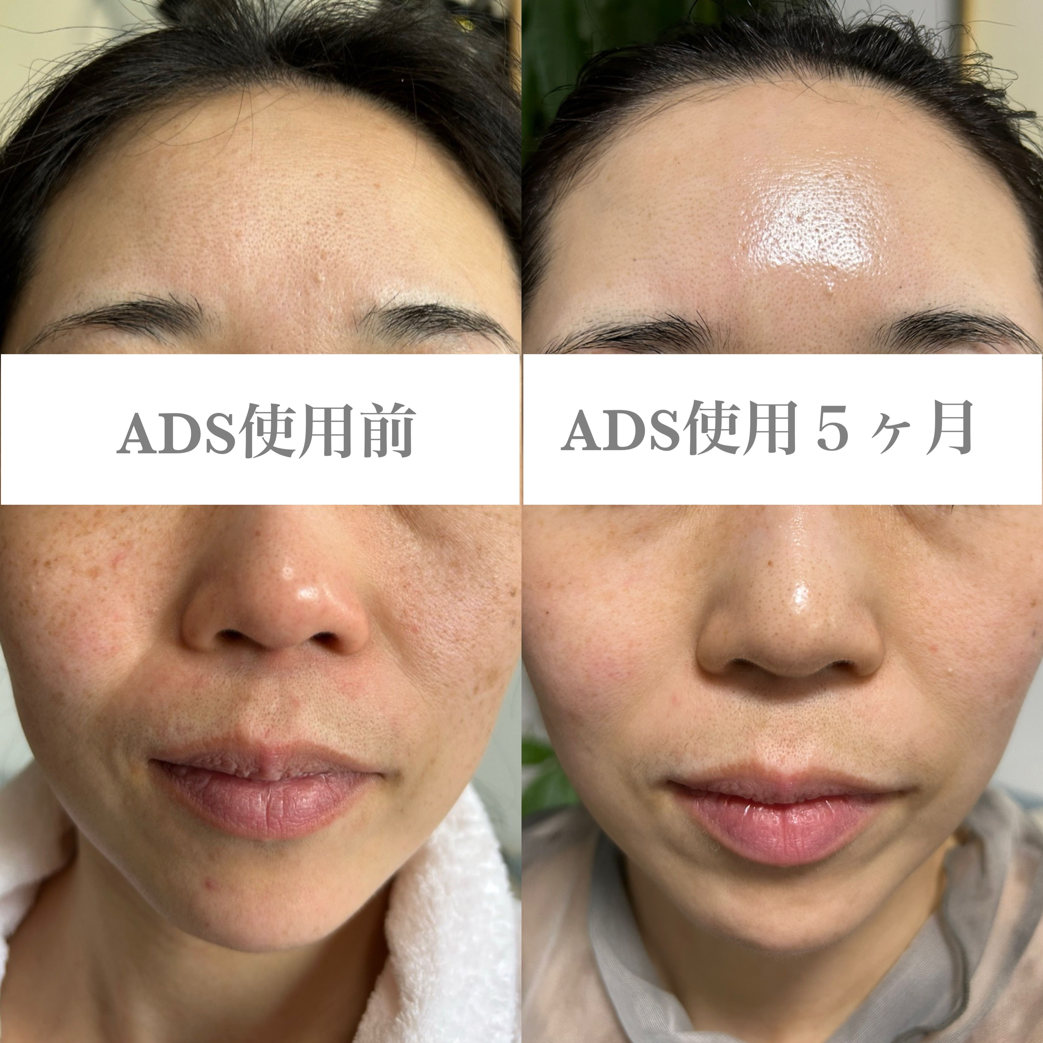 ドクターリセラADS セット 💎ドクターリセラ「ADS リピートセットキャンぺーン」がやってきました